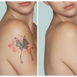 tatoo-removal